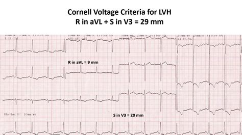 moderate voltage criteria for lvh .